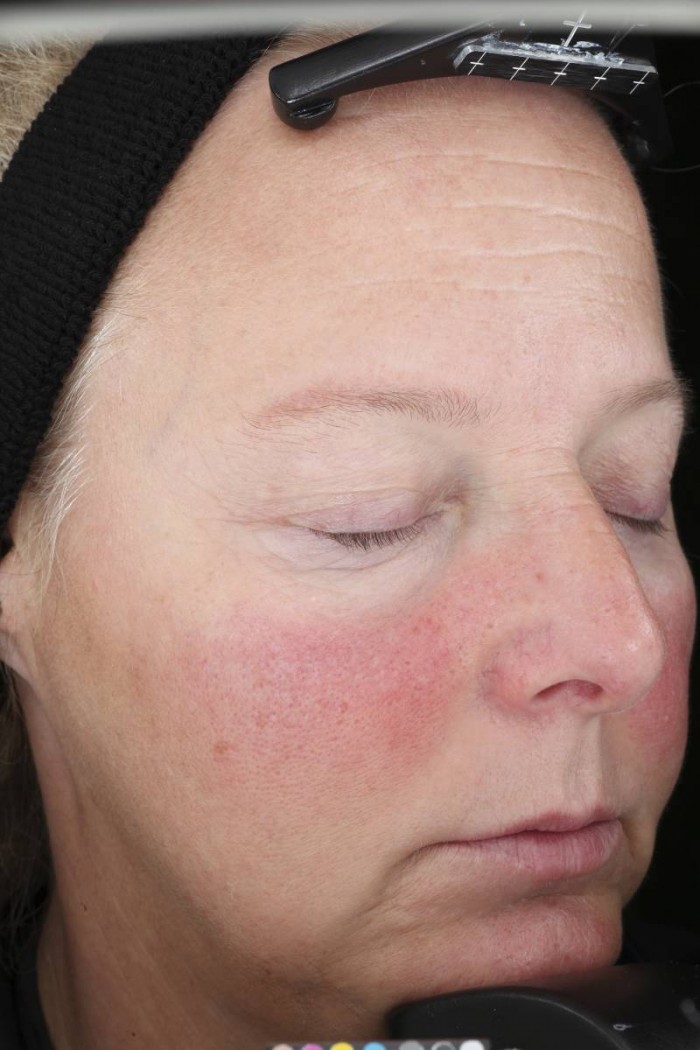 hjälp mot rosacea hjälp mot rosacea